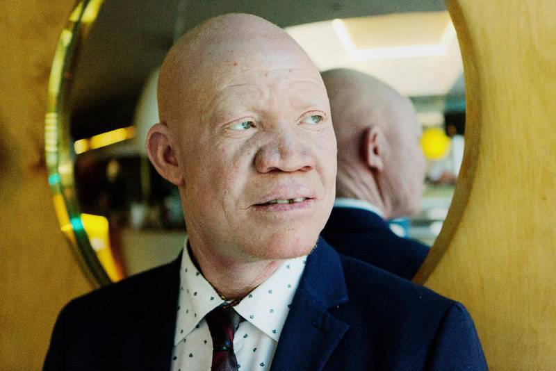 Josephat Torner är en människorättsaktivist som reser runt i bland annat Europa och informerar, nätverkar och bildar opinion. Allt i syfte att förbättra livsvillkoren för personer med albinism. Ett arbete som han är ganska ensam om.