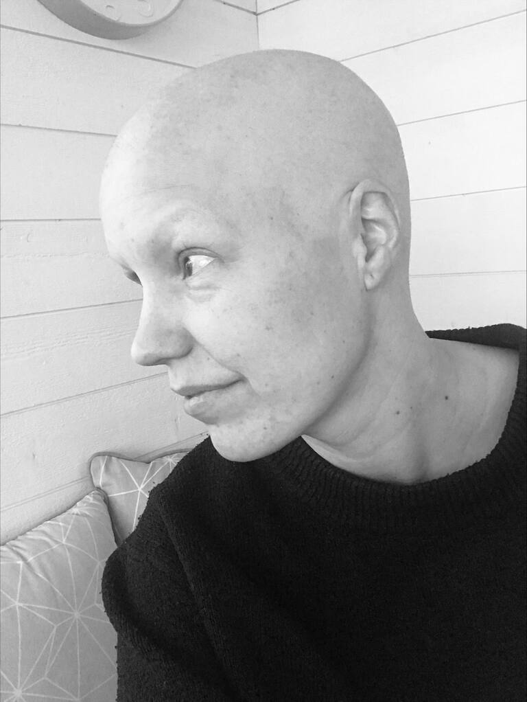 Svartvit bild på pastor Frida Nyberg utan hår under sin cancerbehandling.